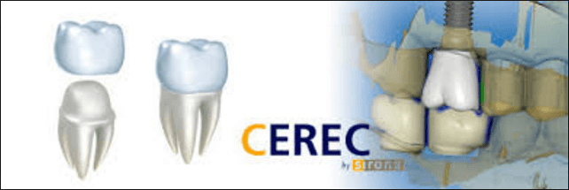 cerec-dental-crowns