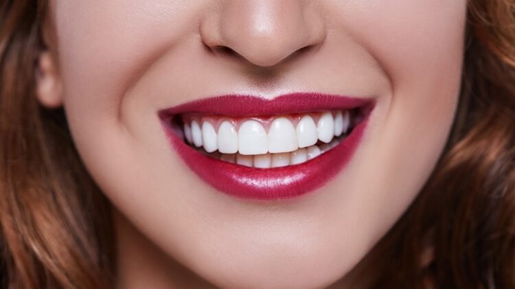 Porcelain Veneers