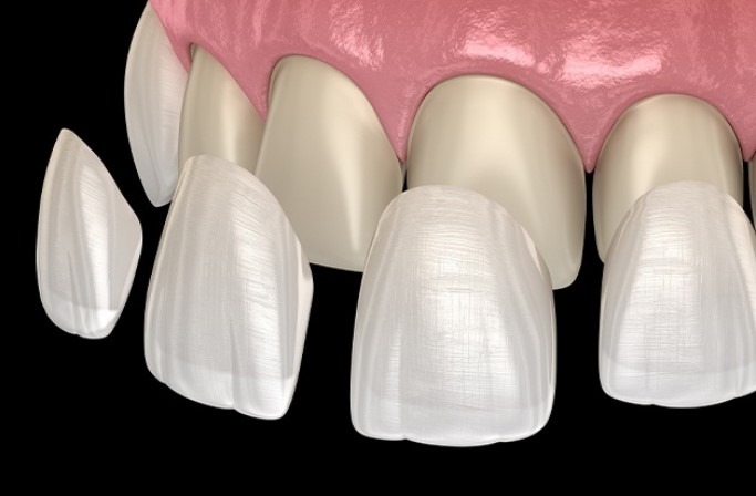 Porcelain Veneers