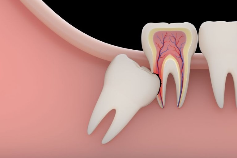 Wisdom Teeth Removal Canberra