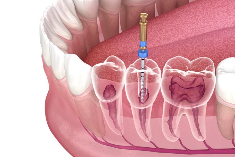 Root Canal Cost