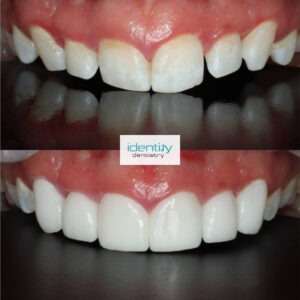 Porcelain Dental Veneers Before and After