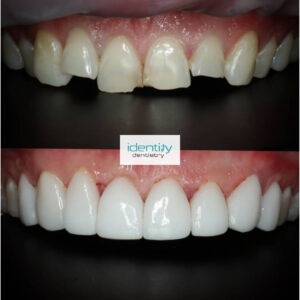 Porcelain Dental Veneers Before and After