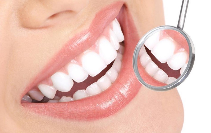 Canberra Teeth Whitening