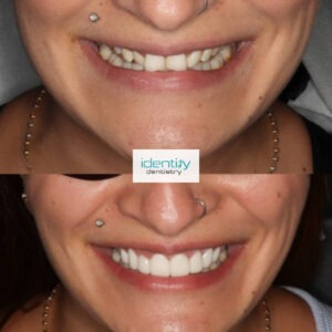 Porcelain Dental Veneers Before and After