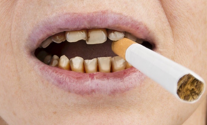 Smoking and Oral Health