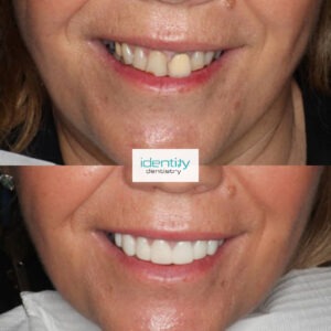 Porcelain Dental Veneers Before and After