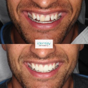 Porcelain Dental Veneers Before and After