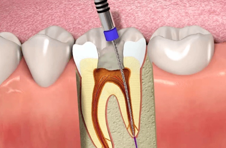 Root Canal Treatment Cost
