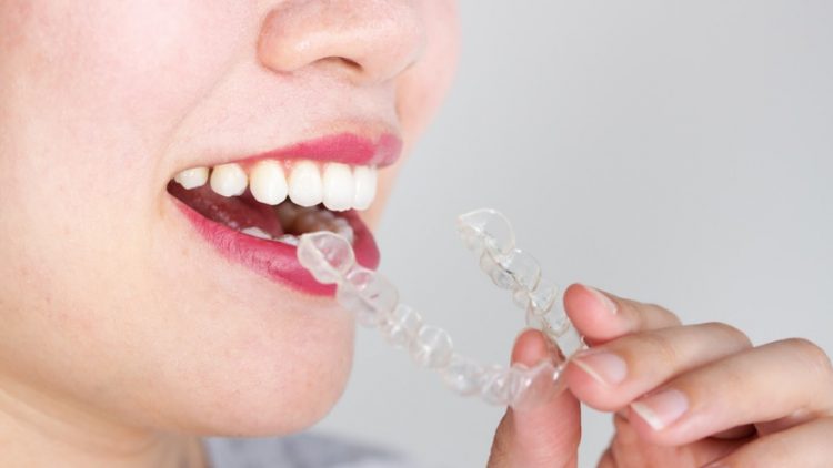 Invisalign Price