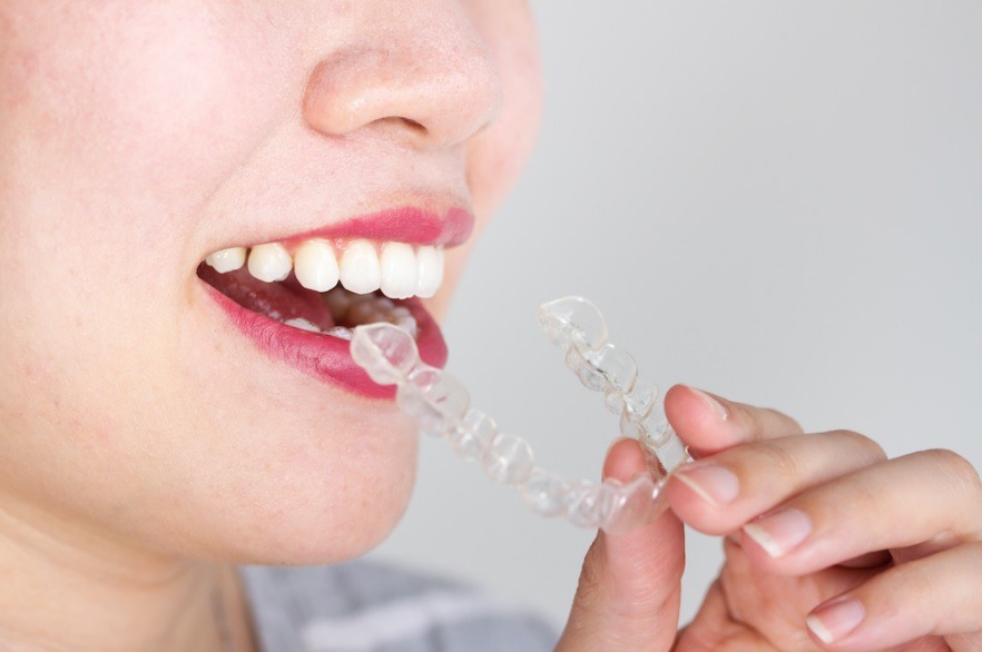 Invisalign Price - Identity Dentistry Canberra City