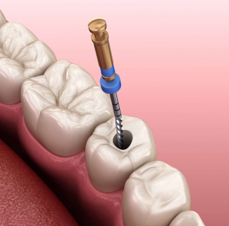 Root Canal Price