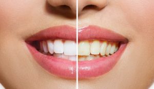 Teeth Whitening Cost