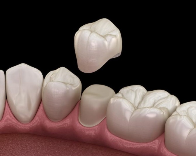 Tooth Crown
