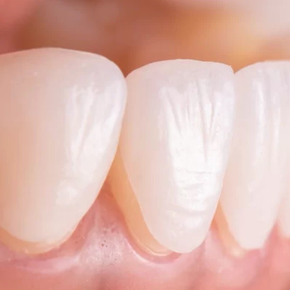 Veneer Teeth