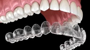 What is Invisalign