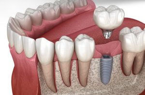 Dental Implants Canberra