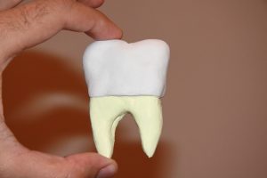 What is a Tooth Cap