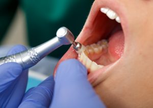 How Much is a Dental Cleaning