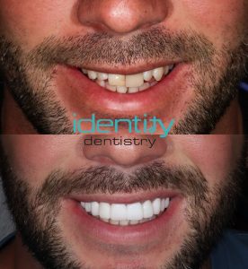 Porcelain Veneers