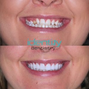 Porcelain Veneers