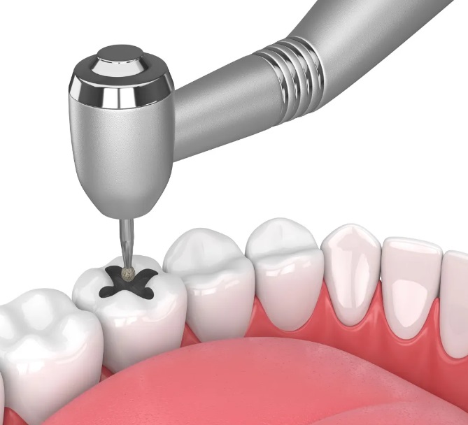 How Much Do Fillings Cost? - Identity Dentistry Canberra City