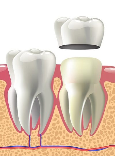 How Much Does A Crown Cost Identity Dentistry Canberra City how-much-does-a-crown-cost-identity-dentistry-canberra-city