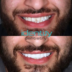 Porcelain Veneers