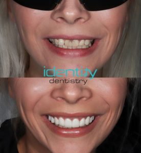 Porcelain Veneers