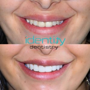 Porcelain Veneers