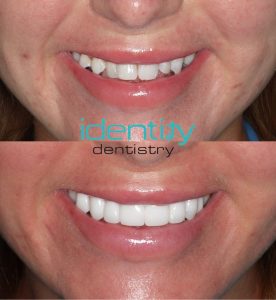 Porcelain Veneers