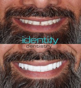 Porcelain Veneers