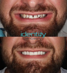 Porcelain Veneers