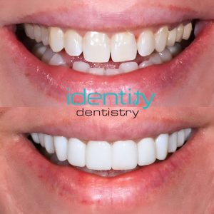 Porcelain Veneers