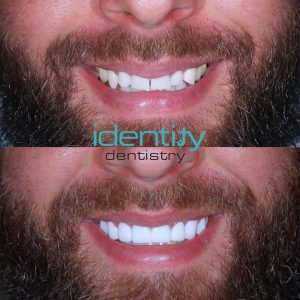 Porcelain Veneers